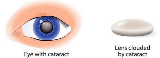 Cataract