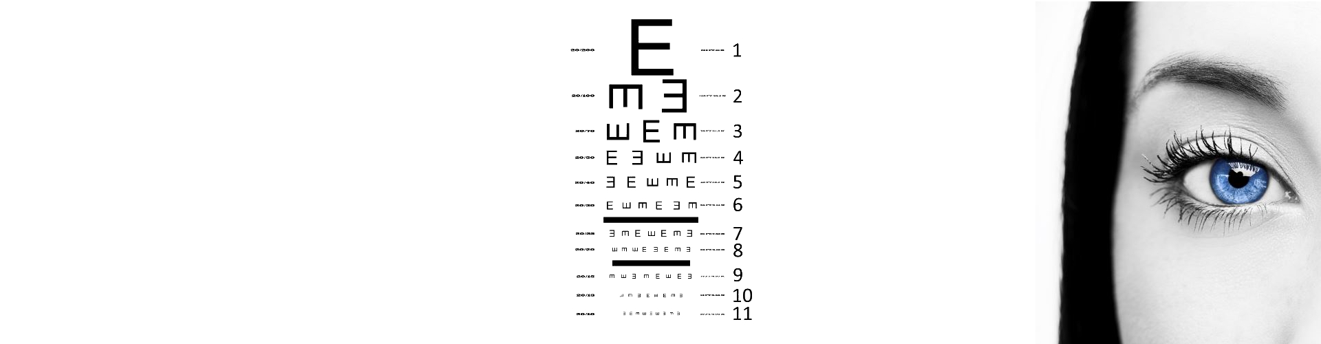 Exsudatieve retinopathie - Diabetes Mellitus - Diabetische Retinophatie - Proliferatieve retinopathie