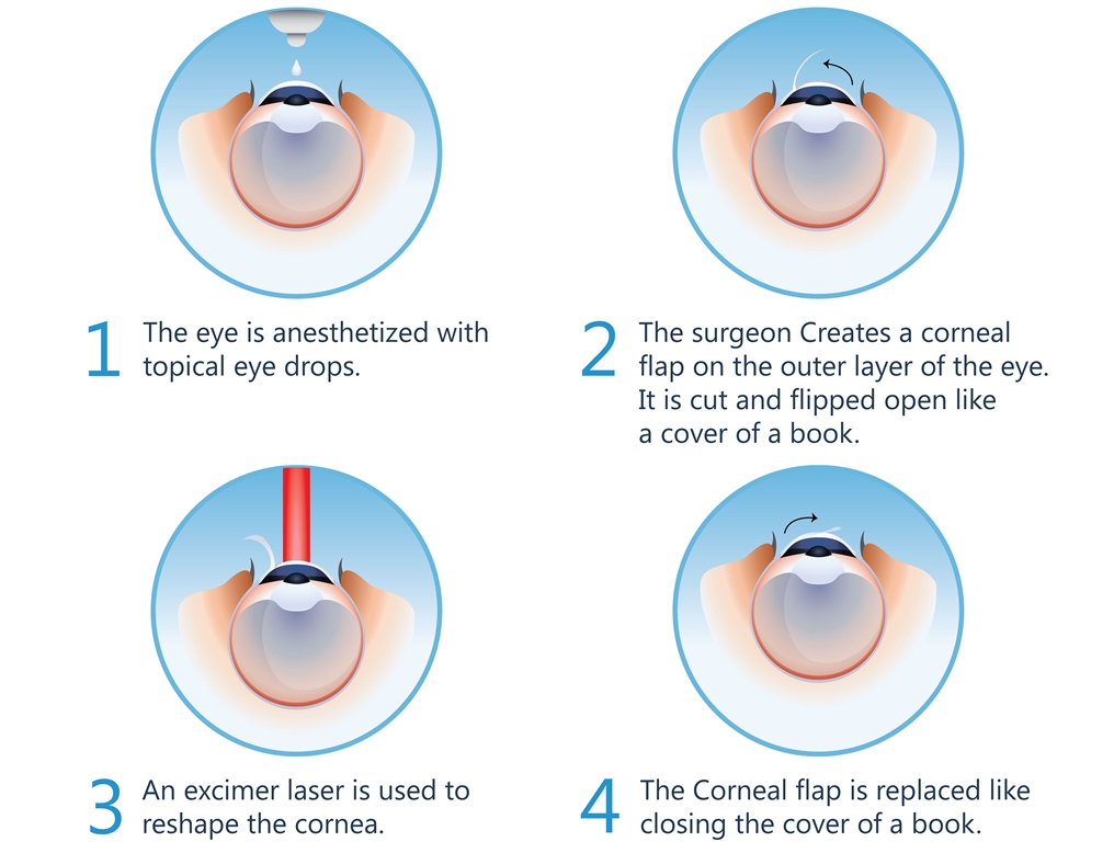 LASIK